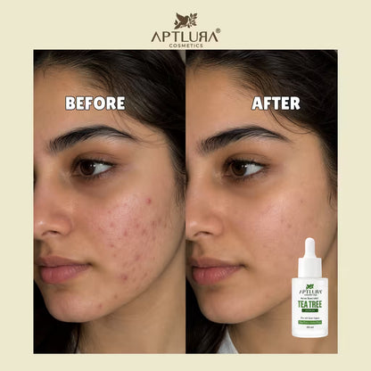 Before and after skin comparison of a woman's face showing acne improvement, with the Aptlura Teefree Teabrown Teeth Whitening & Acne Treatment dropper bottle shown in the bottom right corner.
